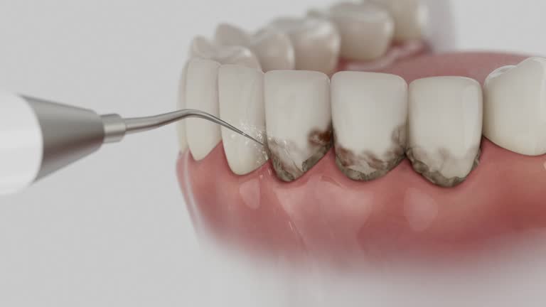 Trusted Wisdom Tooth Removal service in Hanahan, SC - Dentist Open Now